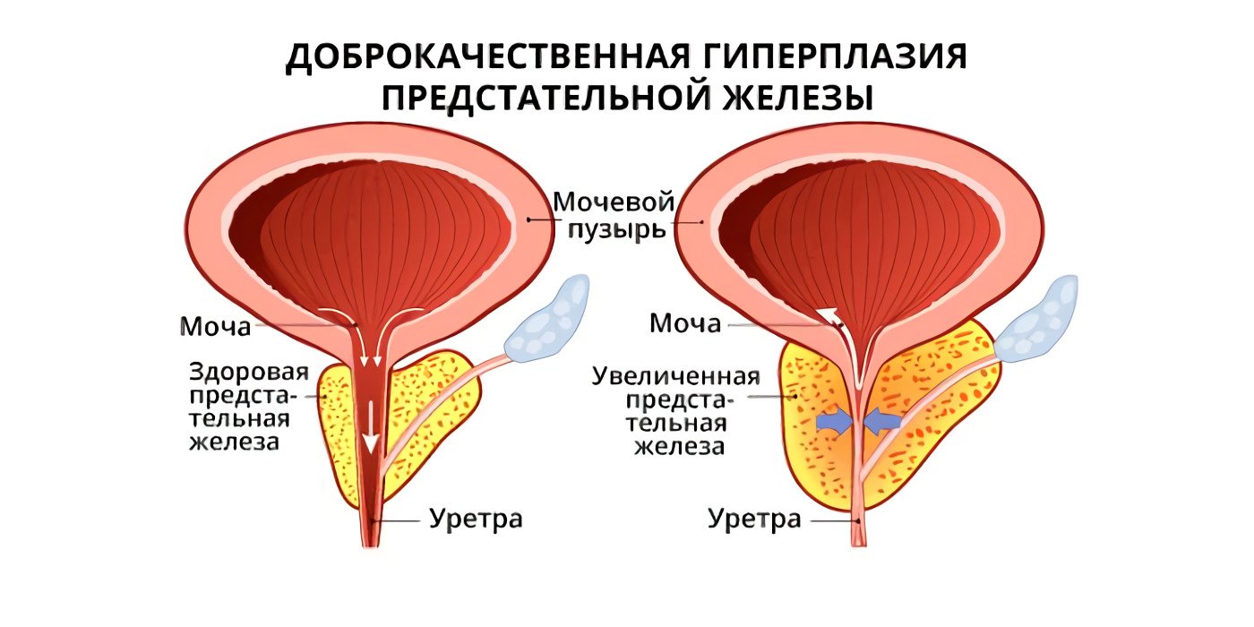 Какие стероиды можно принимать при простатите